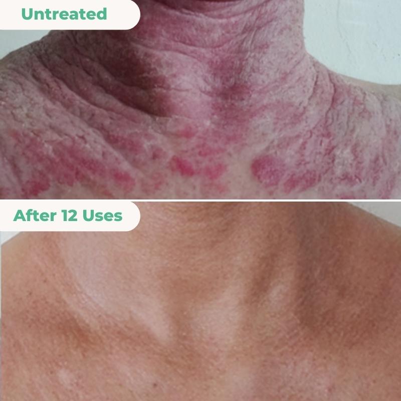 The Complete Eczema Repair System 2.0