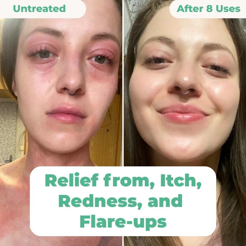 The Complete Eczema Repair System 2.0