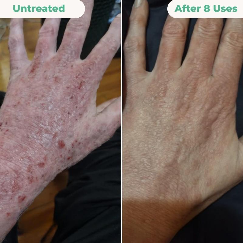 The Complete Eczema Repair System 2.0