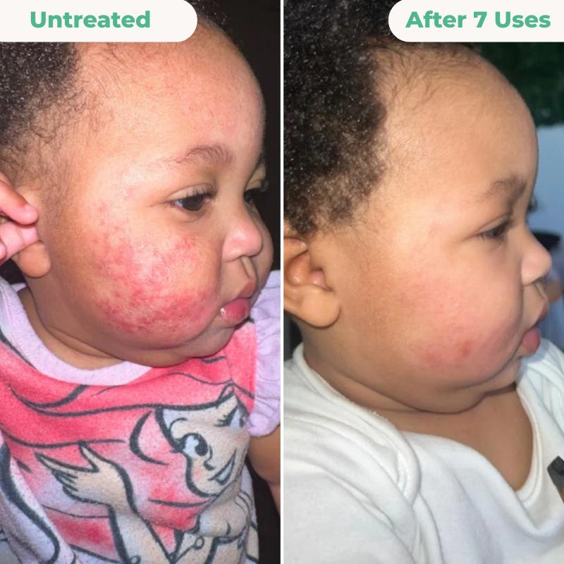 The Complete Eczema Repair System 2.0