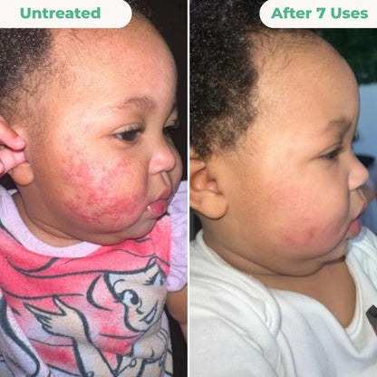 The Complete Eczema Repair System 2.0
